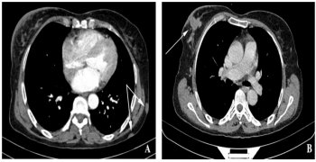 Cutaneous Metastasis from Breast Cancer