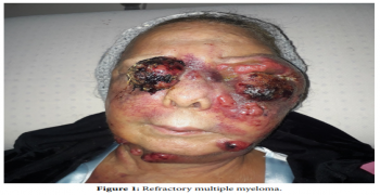 Facial Plasmacytomas in Refractory Multiple Myeloma