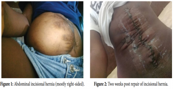Primary Fascial Closure of Large Abdominal Incisional Hernia is Safe and Effective