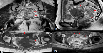 Radiation Enteritis