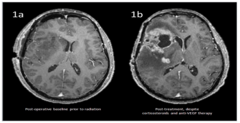Immunotherapy Related Pseudoprogression in a Patient with Glioblastoma