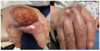 Primary Cutaneous Anaplastic Large Cell Lymphoma.