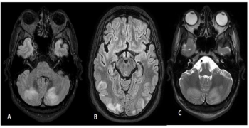 Press Syndrome: An Unusual Complication of Chemotherapy