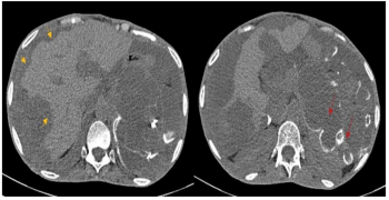 Liver Scalloping: A Suggestive Sign of Pseudomyxoma Peritonei