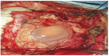 Unruptured Delivery of Posterior Fossa Hydatid Cyst in Child
