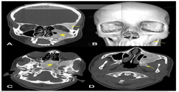 Fibrous Dysplasia of the Face: Typical Ground Glass Pattern