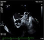 Left Atrial Appendage Thrombus on an Amplatzertm Cardiac Plug Device