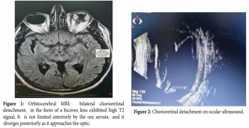 MRI Aspect of Idiopathic Serous Choroidal Detachment: A Case Report of Type III Uveal Effusion Syndrome