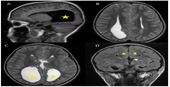 Isolated Complete Corpus Callosum Agenesis: MRI Typical Findings