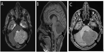 Lhermitte-Duclos Disease: A Radiological Diagnosis to Remember