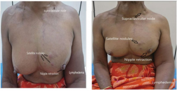 Clinical Signs of Locally Advanced Breast Cancer