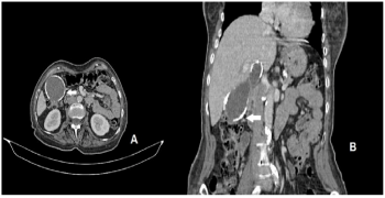 Porcelain Gallbladder