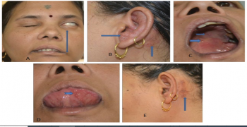 Ramsay Hunt Syndrome