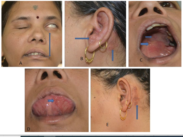 Ramsay Hunt Syndrome