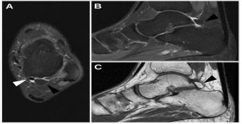 The OS Trigonum and the OS Trigonum Syndrome