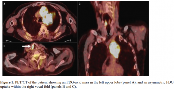 Vocal Fold Paralysis from Recurrent Laryngeal Nerve Compression