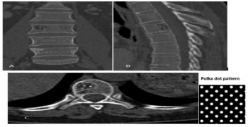 Vertebral Hemangiomas: Polka-dot and Corduroy Sign