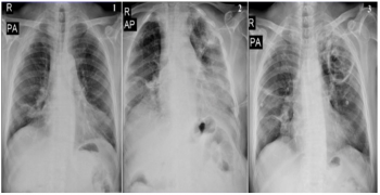 Invasive Cavitary Pulmonary Mucormycosis in an Immunocompetent Patient