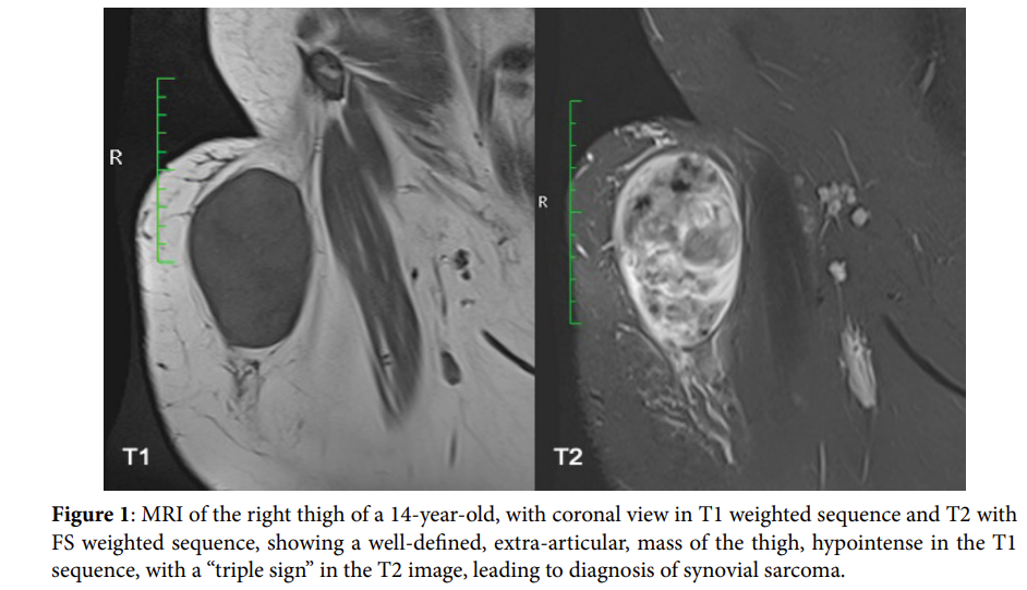Synovial Sarcoma: « Triple Sign » MRI Pattern