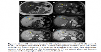 Focal Nodular Hyperplasia: The 7 Characteristic Features on Imaging