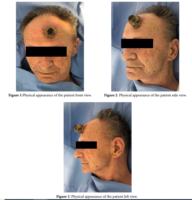 Frontal Horn: A Cutaneous Squamous-Cell Carcinoma of the Forehead Area