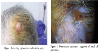 A Disconcerting Case of a Nodular Hidradenoma of the Scalp Simulating a Basal Cell Carcinoma