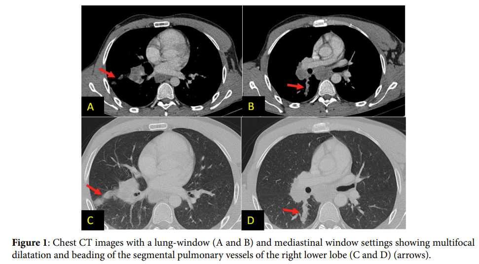 Pulmonary Intravascular Tumour to Emboli Secondary an Extra Skeletal Ewing's Sarcoma