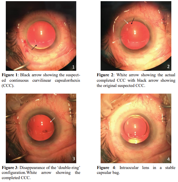 Lens Nucleus-cortex Interface Resemblance of a Continuous Curvilinear Capsulorrhexis in a Virgin Eye