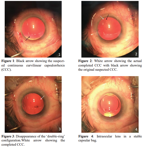 boot Leerling ~ kant Lens Nucleus-cortex Interface Resemblance of a Continuous Curvilinear Capsulorrhexis in a Virgin Eye | International Journal of Clinical & Medical Images boot Leerling ~ kant Lens Nucleus-cortex Interface Resemblance of a Continuous Curvilinear Capsulorrhexis in a Virgin Eye | International Journal of Clinical & Medical Images