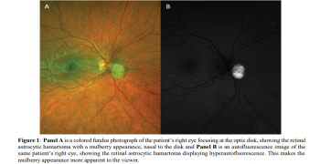 Retinal Astrocytic Hamartoma in Tuberous Sclerosis Complex
