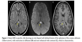 Cytotoxic Lesion of the Corpus Callosum.