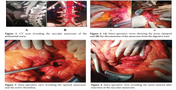 Emergent Surgery of Abdominal Aortic Aneurysm Fistulated into the Jejunum