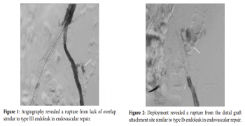 Management of Iliac Artery Rupture in Endovascular Treatment Based on the Endoleak-type System