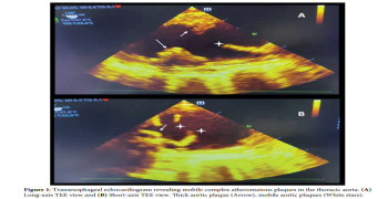 Very Large, Pedunculated and Mobile Plaques in Ascending Thoracic Aorta