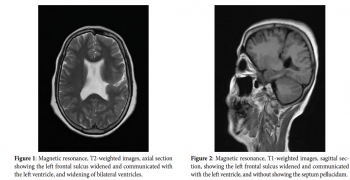 Schizencephaly in the Adult with Epilepsy