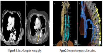 Shock Induced by Iatrogenic Azygos Vein Penetration by Orthopaedic Spine Infusion Procedure