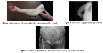 Calcinosis Universalis -A Rare Case of Radial Nerve Entrapment