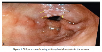 Endoscopic Presentation of an Atypical Diagnosis: A Gastric Xanthelasma