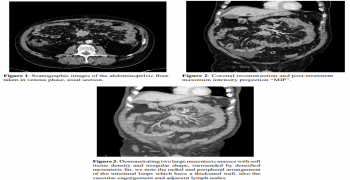 Spoke Wheel Sign of the Mesenteric Carcinoid Tumor