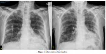 Mechanical Thrombectomy: Paradigm Shift in Treatment for Pulmonary Embolism