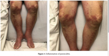 Pancreatic Panniculitis