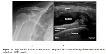 Subacromial-subdeltoid Bursitis Following a COVID-19 Infection