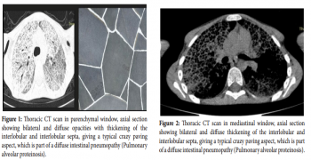 Pulmonary Alveolar Proteinosis in an 11 Year Old Child