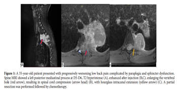 Malignant Schwannoma of Dorsal Spine.