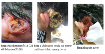 Temporal SCC with Cholesteatoma