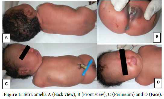 Complete Congenital Absence of all Four Limbs