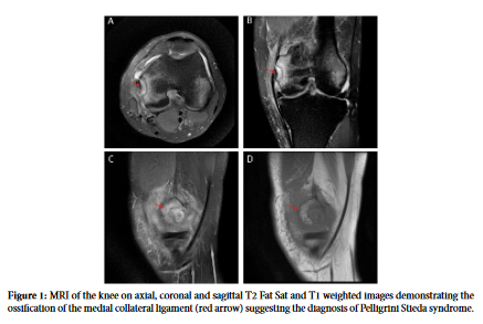 Pelligrini Stieda Syndrome: A Rare Complication of Knee Entorse