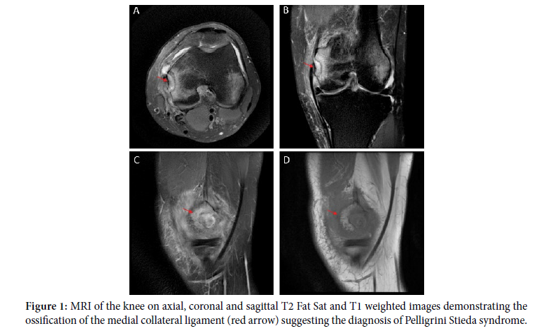 Pelligrini Stieda Syndrome: A Rare Complication of Knee Entorse