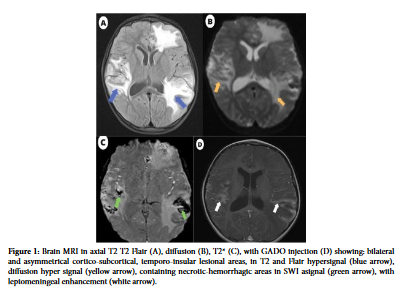 Herpetic Encephalopathy in Children: A Case Report.