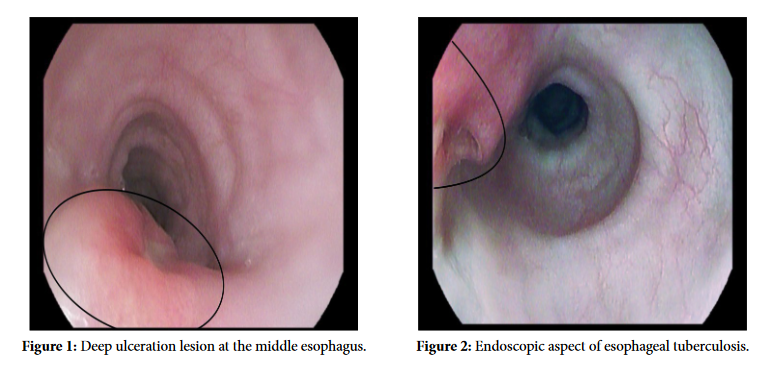 A Case Report on Multifocal Esophageal and Meningitis Tuberculosis - A Rare Entity